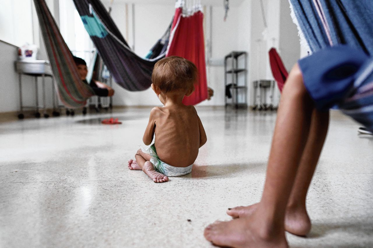 Ondervoede Yanomami-kinderen in het kinderziekenhuis Santo Antonio in de stad Boa Vista, in de deelstaat Roraima.