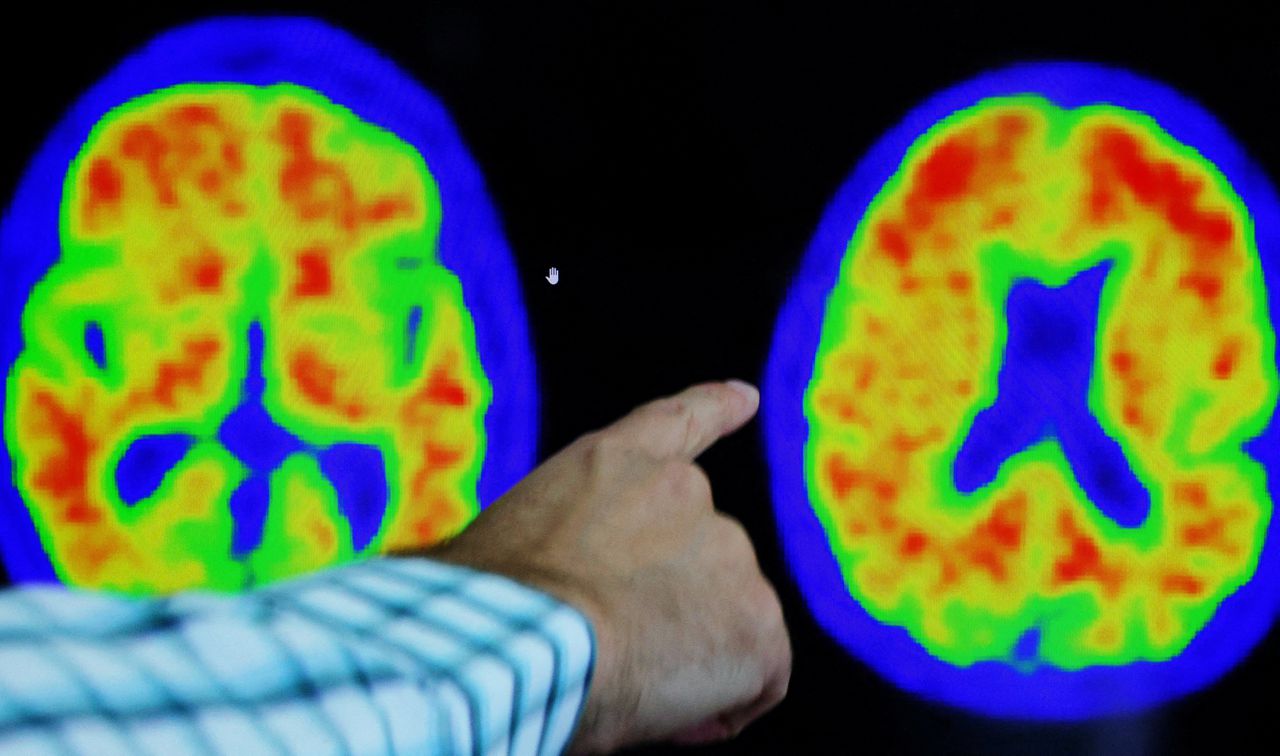 Een Amerikaanse arts wijst op een PET-scan bewijs van alzheimer aan.