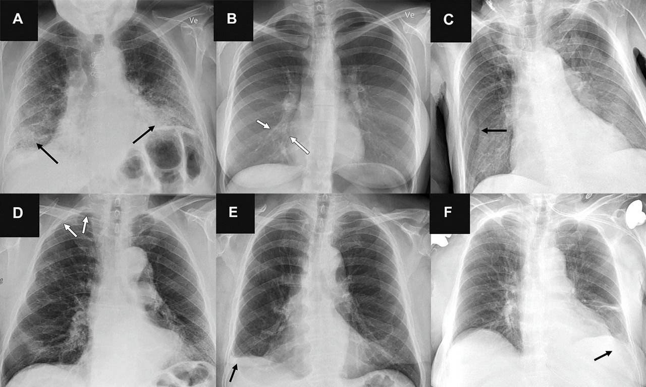 Zes voorbeeldfoto’s waarbij de AI een verkeerde diagnose gaf: (A, C, E) vals-positieve bevindingen en (B, D, F) vals-negatieve bevindingen. De radiologen classificeerden deze voorbeelden wel juist.