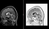 De hersenen in dwarsdoorsnede op een mri-scan.   